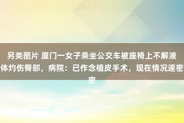 另类图片 厦门一女子乘坐公交车被座椅上不解液体灼伤臀部，病院：已作念植皮手术，现在情况邃密